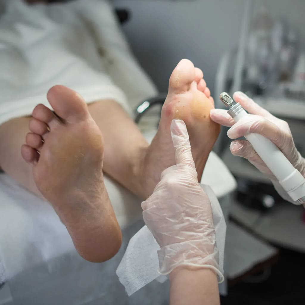 Hühneraugenbehandlung am Fuß