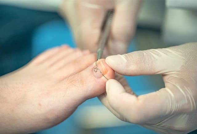Nagelkorrekturspange am Fuß